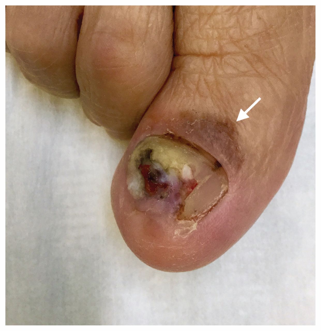 Figure 14 from Dermoscopy in the Evaluation of Nail Disorders | Semantic  Scholar